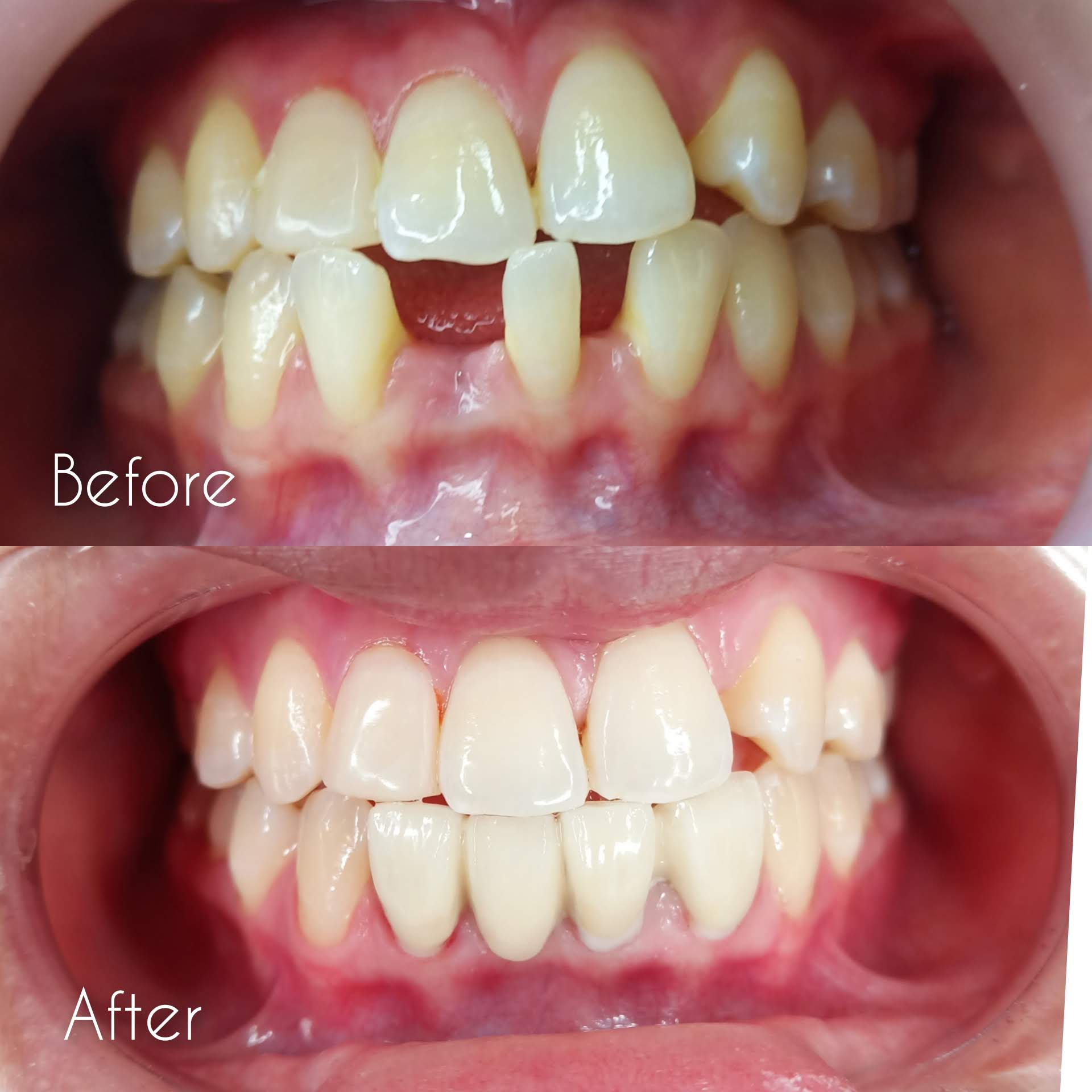 Dental Implants Senawang 11 dental implants senawang