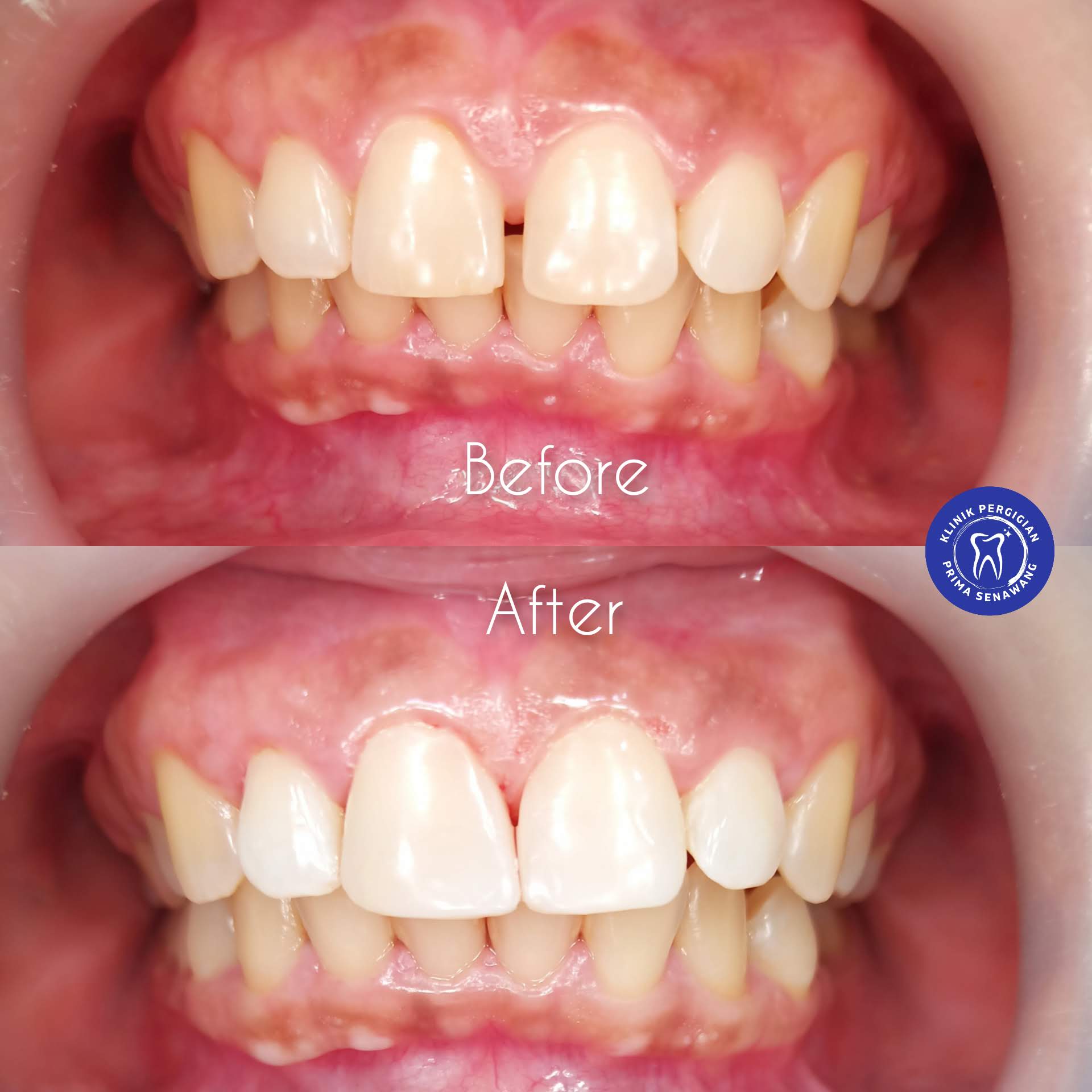 Dental Fillings Senawang 11 dental filling senawang