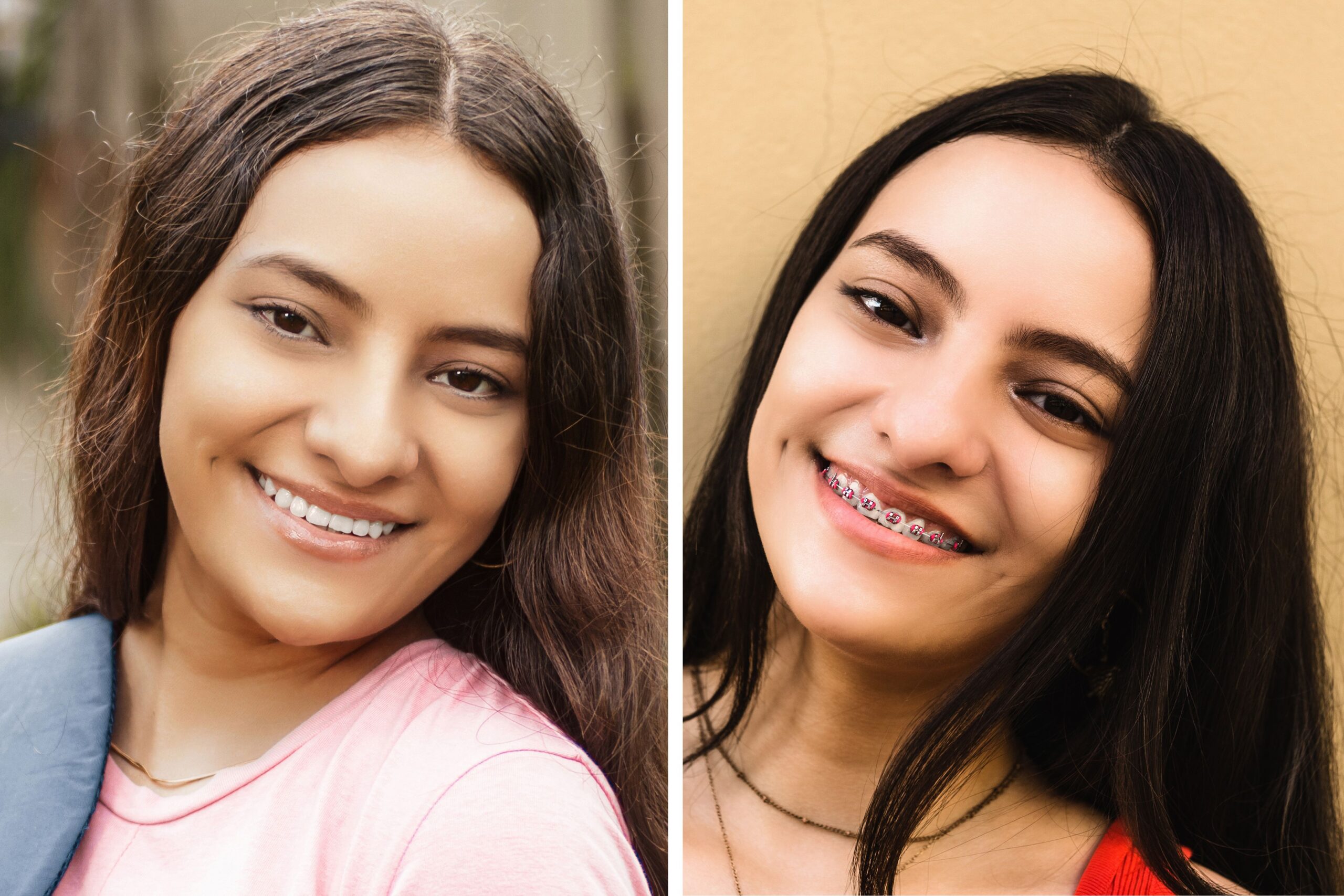 How to Fix Overbite with Braces and Invisalign? 1 What to Expect When Getting Braces to Fix Your Overbite