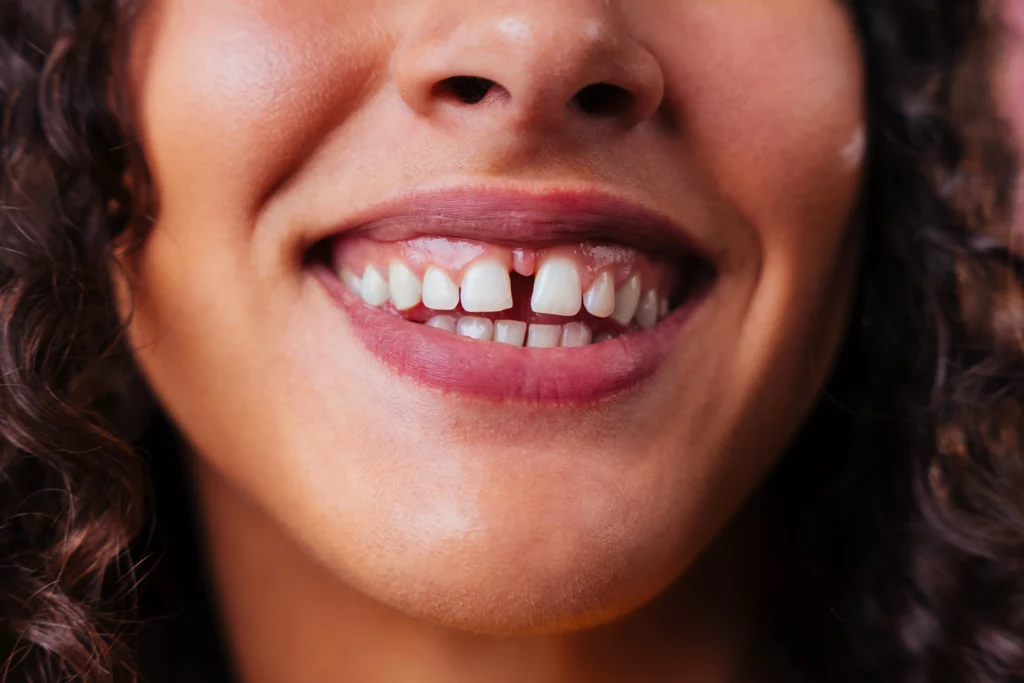 Understanding Diastema (Teeth Gap) and How To Fix It 6 how to fix teeth gap woman with teeth gap klinik pergigian prima senawang