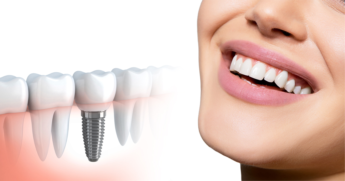 Dental Implants